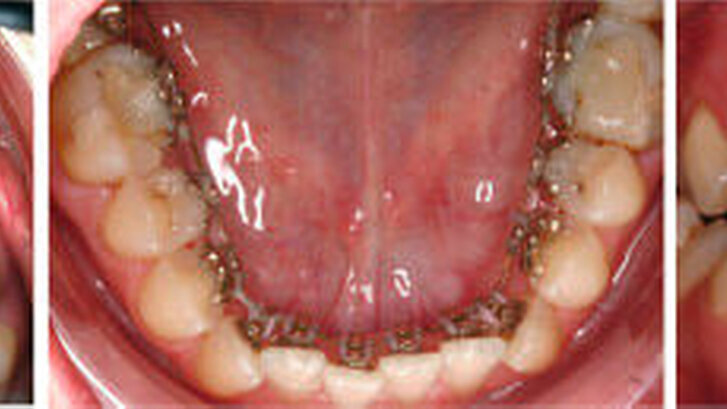 Abbildung 3: b) Eingesetzte individualisierte linguale Apparatur in Ober- und Unterkiefer, von frontal nicht sichtbar |