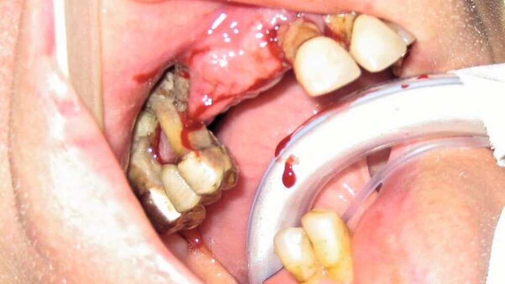 Abbildung 4: Operationssitus mit deutlich sichtbarem Knochensequester Regio 14 bis 16. |