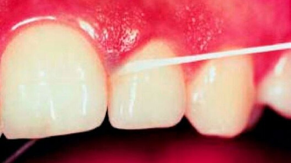 Mit Zahnseide können approximale Beläge optimal entfernt werden. Ist die Seide fluoridiert, erhält der Zahnschmelz zusätzlich einen Prophylaxeschutz.