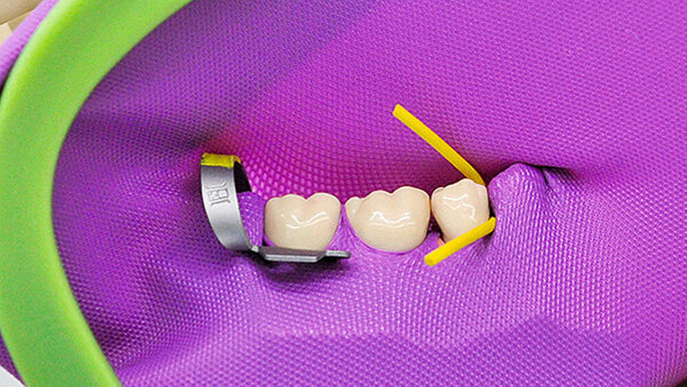 Fixierung 4: Zur interdentalen Fixierung sind heute Wedjets üblich. |