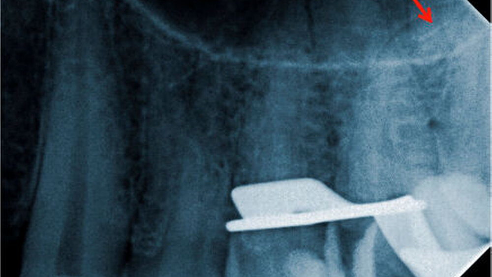 Abbildung 2: Ein circa 2 bis 3 mm langes Bruchstück ist im apikalen Wurzeldrittel des mb1 hinter der Krümmung frakturiert. |