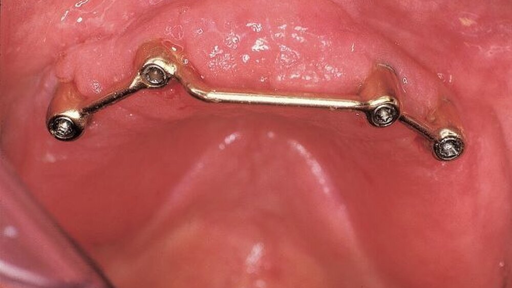 Abbildung 11 : Steg auf vier Implantaten in der Oberkieferfront