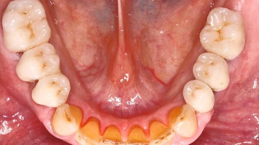Abbildung 2: 34, 36 implantat - getragene Metall - keramikkronen Zahn 35 wurde mit metallkeramischer Krone, die Zähne 44 und 46 wurden mit metallkeramischer Brücke versorgt.