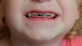 Zerstörtes Kindergebiss