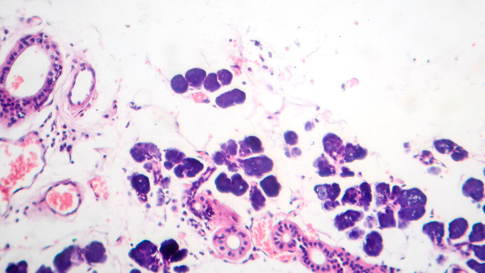 Mixed parotid tumor, photomicrograph showing epithelial and myoepithelial cell components within chondromyxoid stroma, typical of pleomorphic adenoma. Mixed parotid tumor, photomicrograph showing epithelial and myoepithelial cell components within chondromyxoid stroma, typical of pleomorphic adenoma.