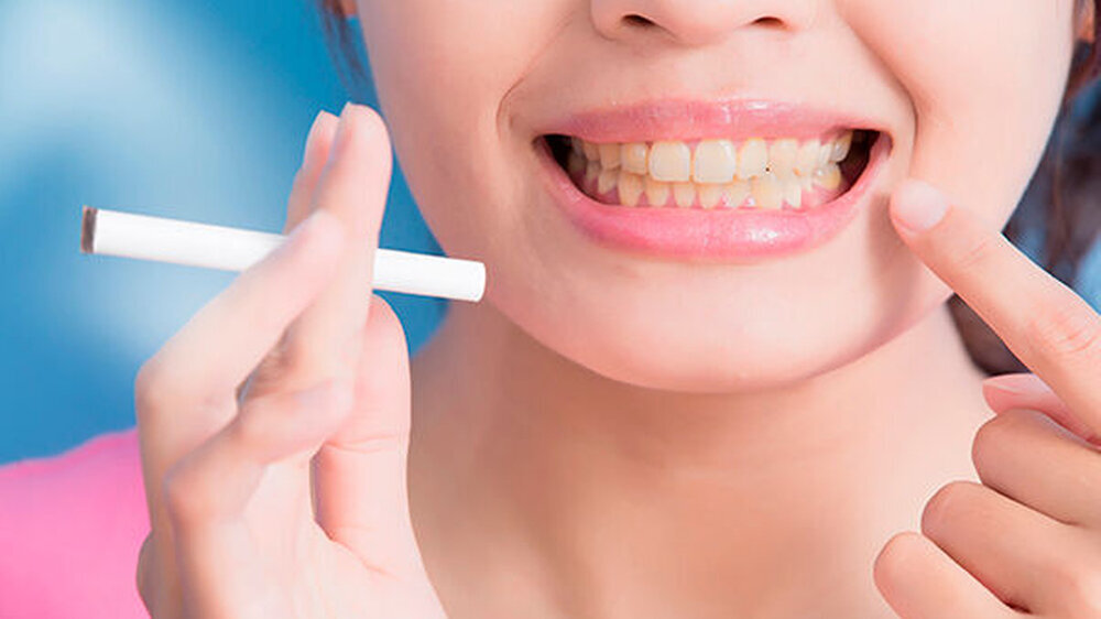 Der gemessene Whiteness index for dentistry der ehemaligen Raucher befand sich zwischen den Werten der Raucher- und der Nichtrauchergruppe. Wechselten Raucher von Zigaretten zu E-Zigaretten, hellte sich ihre Zahnfarbe laut Studie am Ende des Untersuchungs