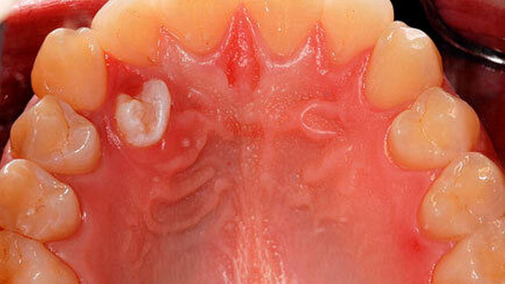 2e: Klinische Ansicht des Gaumes mit eruptiertem 14+. |