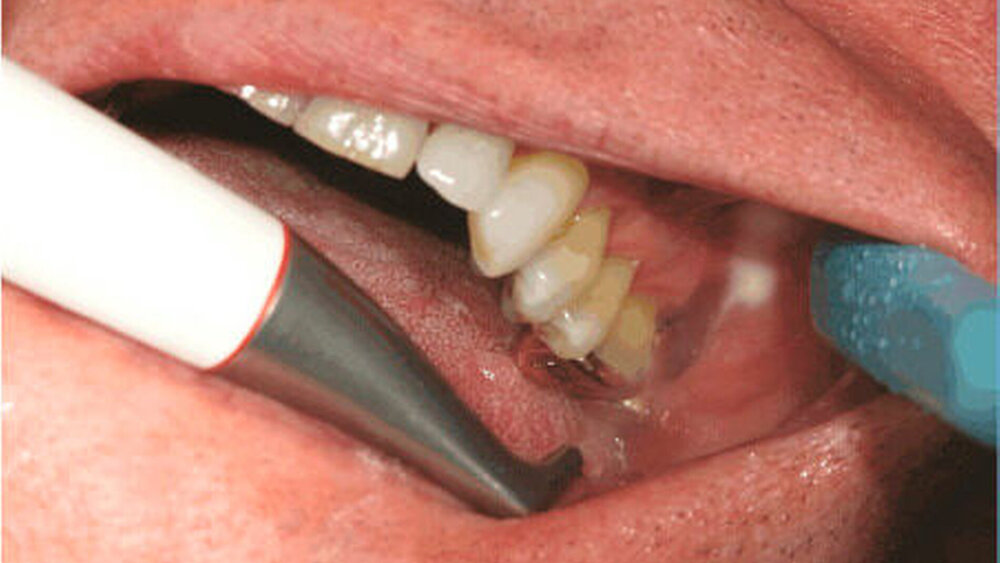 Prophylaxe mit Air-Flow Handstück |