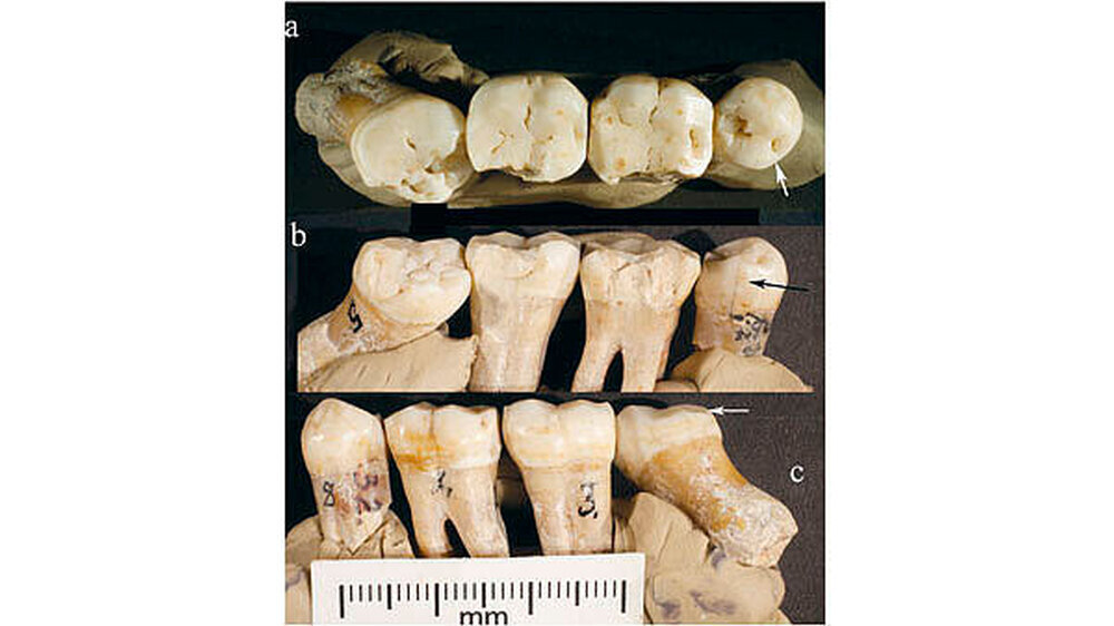 Die okklusale Ansicht (a) zeigt von lingual die mesiale interproximale Schlifffacette bei P4 (Pfeil) und den bukkalen Verschleiß bei M3; b: Die linguale Ansicht zeigt mesial die interproximale Schlifffacette bei P4 (Pfeil), Risse bei allen Zähnen und de