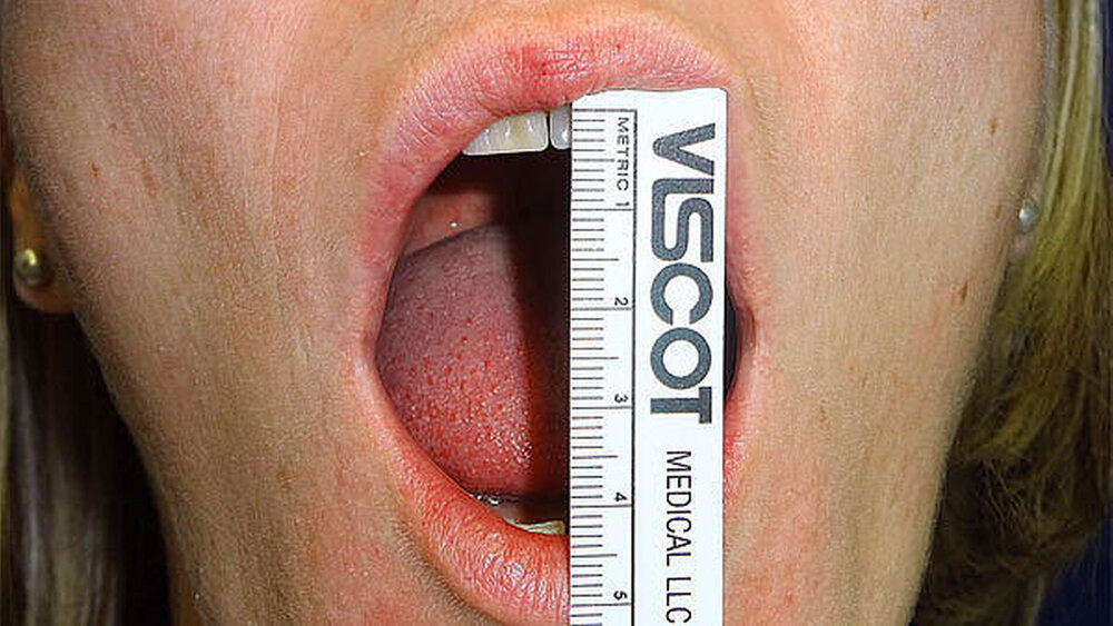 Mundöffnung drei Monate nach der Operation. |