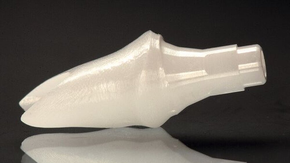 Abbildung 3: Bei dünner Mukosa verhindert das ZrO2-Abutment das Durchschimmern des Titan-Enossalpfeilers. |