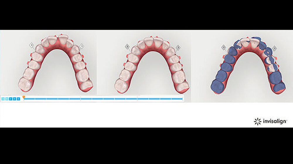 3D-Modell der Zahnbewegung im Oberkiefer im Planungstool ClinCheck