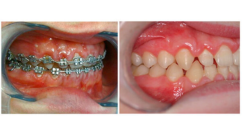 Abbildung 3: Gingivahyperplasie (links) bei der Multibrackettherapie: Eine Rückbildung erfolgt größtenteils spontan (hier im Zustand nach drei Monaten). |
