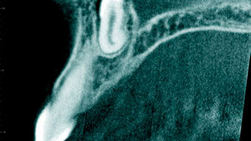 Abbildung 20: Überzähliger Zahn im Oberkieferfrontbereich (Mesiodens) mit einer konischen Form bei einem elfjährigen Mädchen mit Durchbruch in die Nasenhöhle (b: sagittaler Schnitt). |