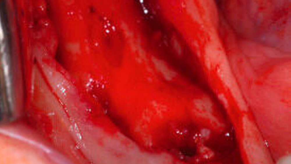 Abbildungen 5a und 5b: Darstellung des Knochens mit deutlich veränderter Oberfläche bei Bestehen von multiplen Osteolysen (a): Bei Präparation nach cranial wurde die Eröffnung des in Abbildung 2a dargestellten Verhalts unter Abgang von eitrigem Sekret vorgenommen. |