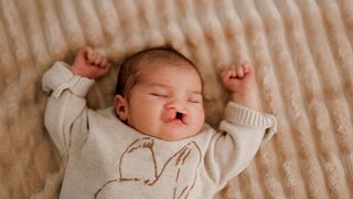 A sleeping newborn baby with congenital defect of cleft lip and palate wrapped in a cozy blanket, resting peacefully in a crib. The baby has a serene expression