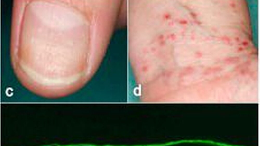 Abbildung 10: Der Lichen ruber zeigt sich klinisch mit a: schmerzhaften flächigen Erosionen der Mundschleimhaut, teilweise mit b: netzförmiger, weißlicher Streifung (Wickhamsche Streifung). c: An den Nägeln sieht man verdünnte Nagelplatten mit Tüpfeln. d: An der Haut sind stark juckende polygonale Papeln typisch. e: In der direkten Immunfluoreszenz einer periläsionalen Biopsie findet man bandförmige Ablagerungen von Fibrinogen an der Basalmembran mit netzförmigen Ausläufern in die obere Dermis. |
