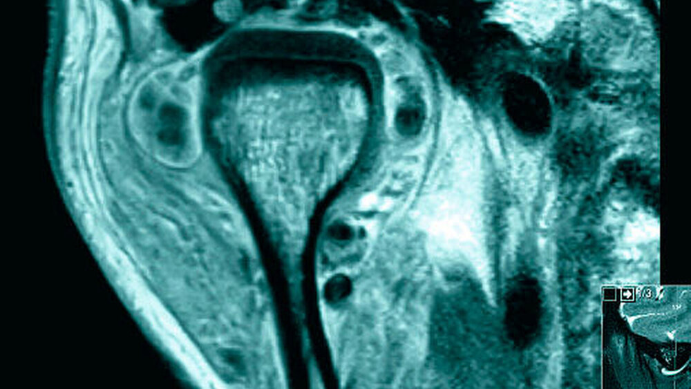 Abbildung 2: In der MRT-Bildgebung zeigen sich multiple chondromatoide Strukturen, die dem Signal des Diskus articularis ähnlich sind. Dieser befindet sich in regelrechter Position innerhalb des Kiefergelenks. Die multiplen Fremdkörper zeigen teilweise einen Kontakt zur Synovialmembran, liegen jedoch im Wesentlichen innerhalb der Gelenkkapsel. |