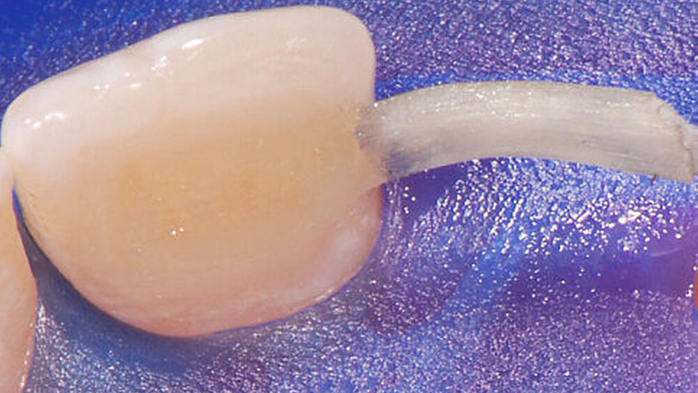 Der vorimprägnierte Glasfaserstrang everStick® CB wurde mittels x-flow A3 befestigt. |