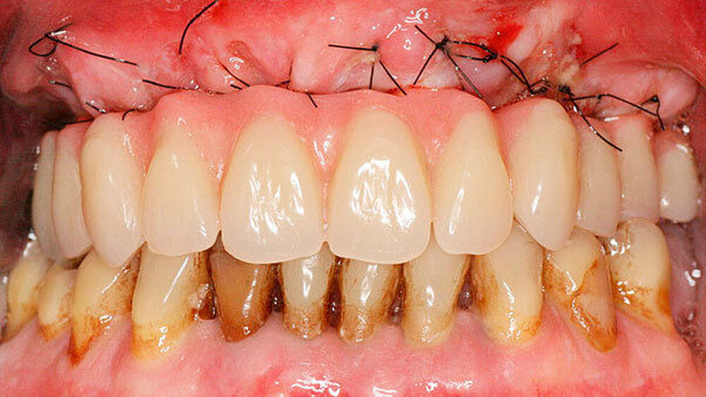 Abbildung 1d) Frontalansicht: Inkorporierter Zahnersatz am Folgetag. |