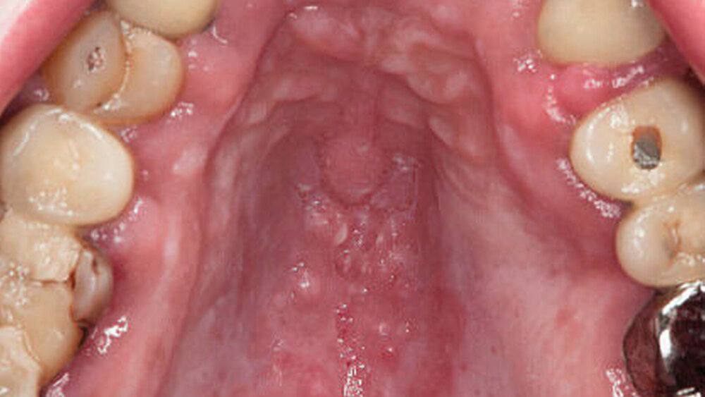 Abbildung 3: Erythematöse Candidiasis am Gaumen eines HIVpositiven Patienten ohne antiretrovirale Therapie (Patient männlich, 49 Jahre) |