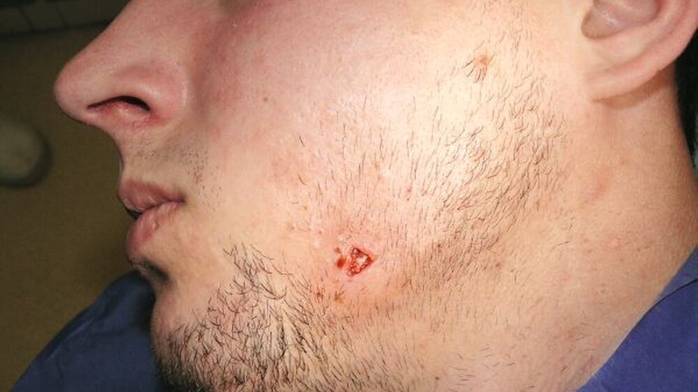 Der Patient nach Inzision von extraoral im Nachgang einer Weisheitszahnextraktion.