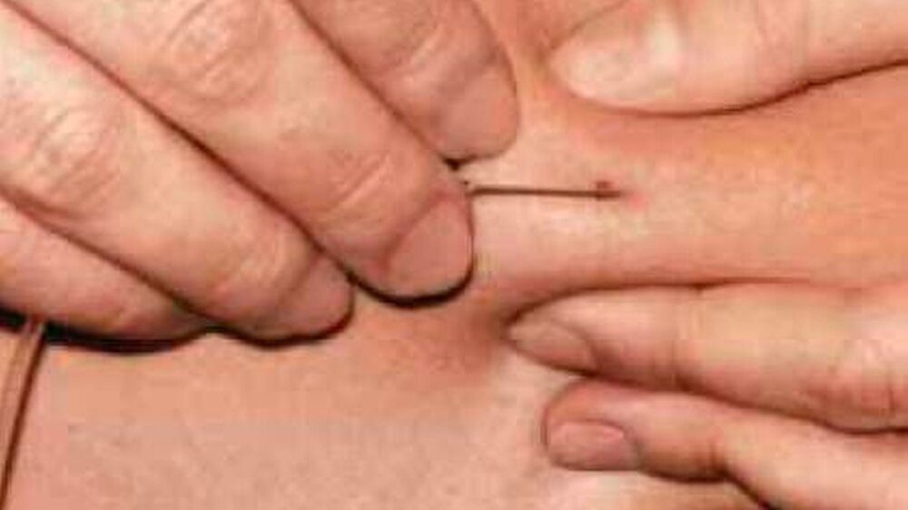 Die bisherige Behandlung mit Deferoxamin erforderte fast täglich eine subkutane Dauerinfusion über acht bis zwölf Stunden, die teilweise sehr schmerzhaft war.