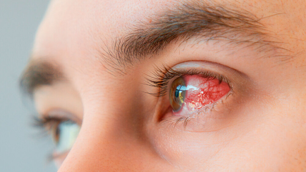 Close up of male brown bloodshot eyes and redness with vessels. Concept of keratitis, inflammation and ophthalmology Keratitis