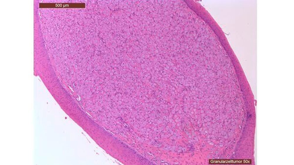 Abbildung 3: Histologisch aufbereitetes Präparat in H.E.-Färbung. Man sieht deutlich die Außenwand des Tumors.