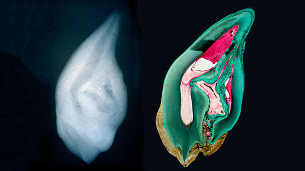 Abbildungen 1a und 1b: Deformierter Zahn mit einer Invagination, die vom Foramen caecum bis in die apikale Wurzelhälfte reicht |
