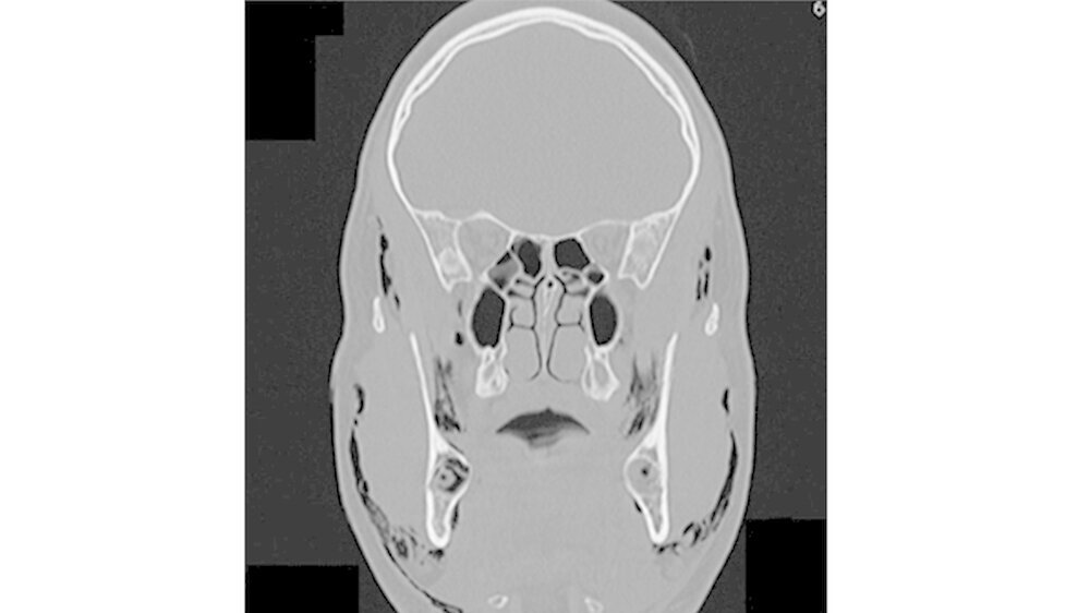 Abb. 4: Der frontale CT-Scan des Kopf- und Halsbereichs zeigt eine beidseitige Luftansammlung im Gewebe von der Temporalisfaszie bis zur Supraclavicularregion.