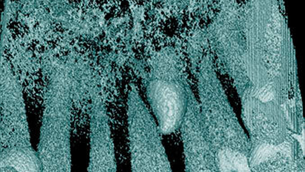 Abbildung 9: Überzähliger Zahn im Oberkieferfrontbereich (Mesiodens)mit einer konischen Form bei einem 14-Jährigen (c: dreidimensionale Bildrekonstruktion). |