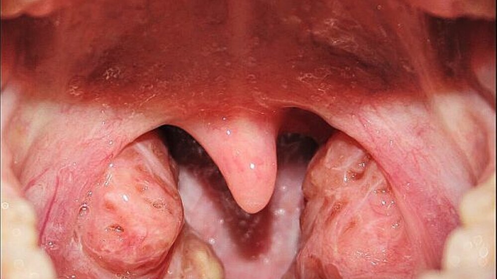 Abbildung 1: Typisches Bild bei chronischer Tonsillitis mit kryptenreicher Oberfläche