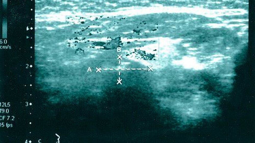 Abbildung 3: Sonografischer Befund des echoreichen Speichelsteins der Gl. sumandibularis rechts |