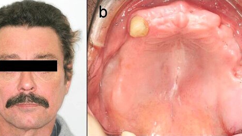 Abbildung 1: Klinischer Befund\r\na) extraoral: diskrete linksseitige Gesichtsschwellung mit leicht verstrichener Nasolabialfalte\r\nb) intraoral: etwa 2 x 3 cm messende derbe Auftreibung im Bereich des linken Tubers