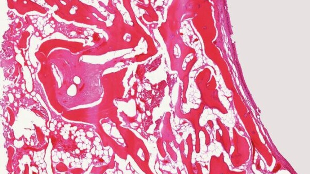 Abbildung 6: Anteile des Osteoms aufgebaut aus reifem, überwiegend lamellärem Knochengewebe; zwischen den Knochenbälkchen liegt lockeres fibrovaskuläres Stroma und Fettmark; am rechten Bildrand Überkleidung durch respiratorisches Epithel (HE-Färbung, 30x Vergrößerung). |