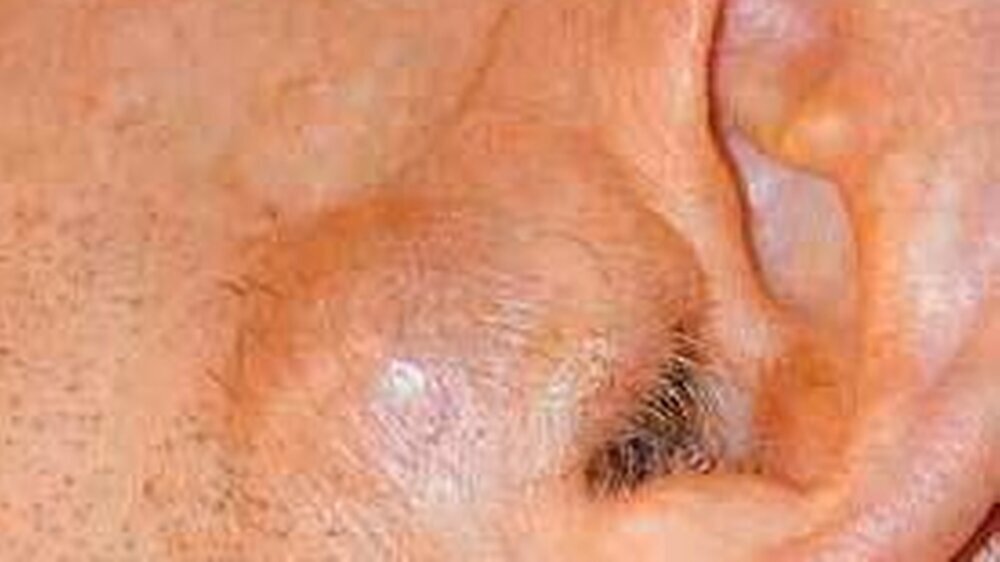 Abbildung 1: Klinischer Befund vor der operativen Entfernung. Es handelt sich um eine vor dem Meatus acusticus externus gelegene halbkugelige, knapp zwei Zentimeter große Schwellung. Cranial liegt die eingeheilte Spalthaut nach der Spinaliomresektion. Au
