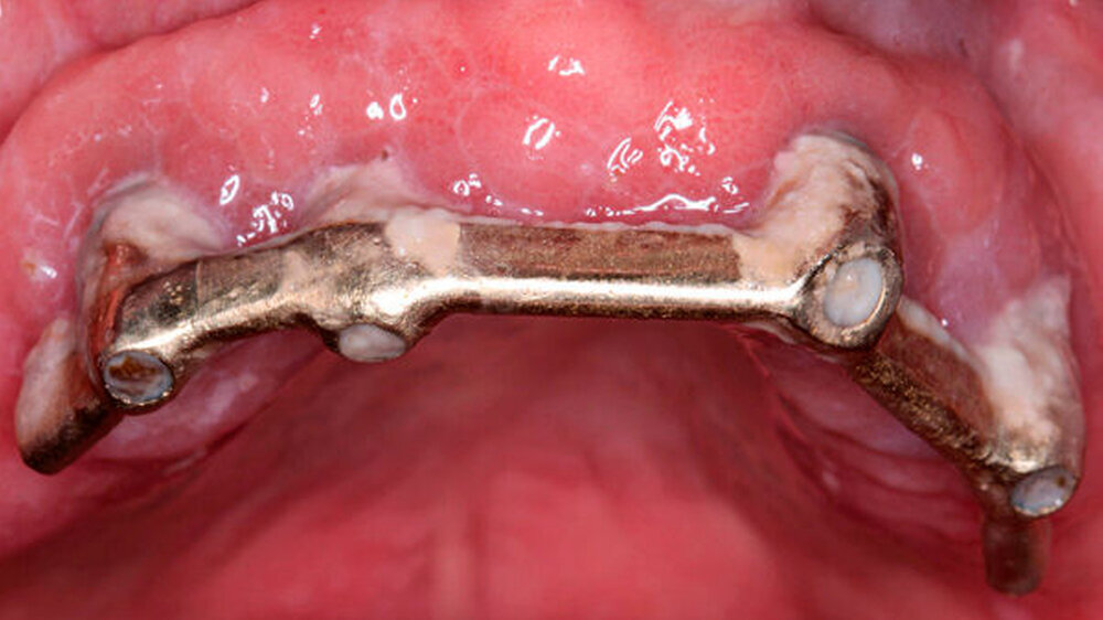Abb. 1: Implantatgetragene Stegversorgung im Oberkiefer mit starker Biofilmanhaftung und
entsprechenden Entzündungszeichen des periimplantären Gewebes