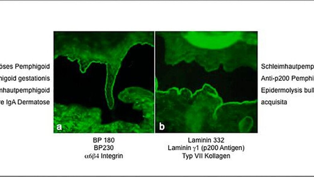 Abbildung 9: In der indirekten Immunfluoreszenz auf humaner Spalthaut binden Serumautoantikörper bei Pemphigoiderkrankungen abhängig vom Zielantigen entweder an die epidermale (links) oder an die dermale Seite (rechts) des artifiziellen Spaltes. Die entsprechenden Zielantigene und Pemphigoiderkrankungen sind unterhalb beziehungsweise seitlich angegeben. |