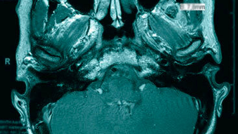 Abbildung 2: T1 gewichtete MRT-Aufnahmen mit markiertem Abszess a) mit Kontrastmittel |