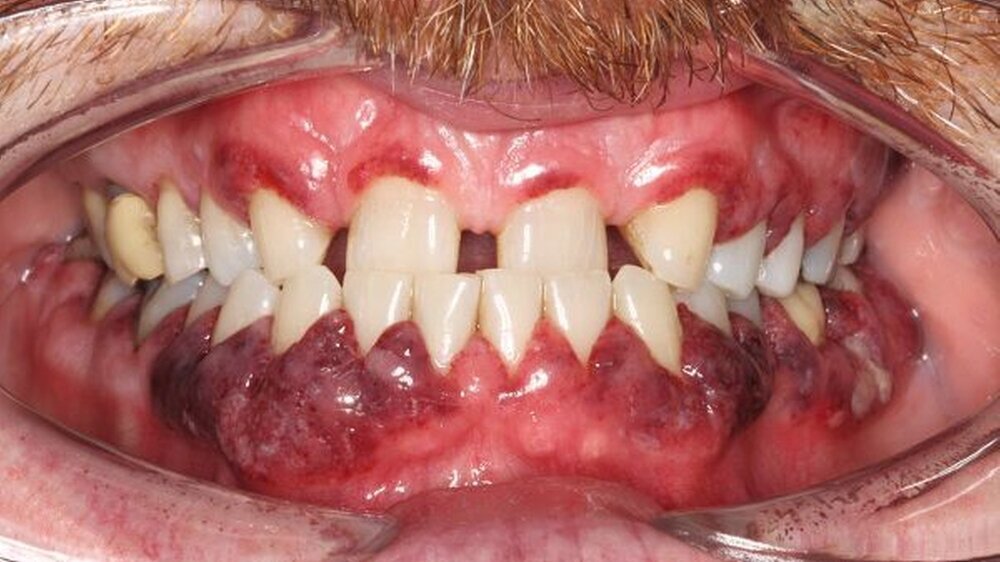 Abbildung 1: Intraoraler Befund: hyperplastische Gingivitis mit girlandenförmiger Rötung der marginalen Gingiva: In regio 36/37 ist ein ulzerierend-nekrotisierendes Areal zu erkennen.