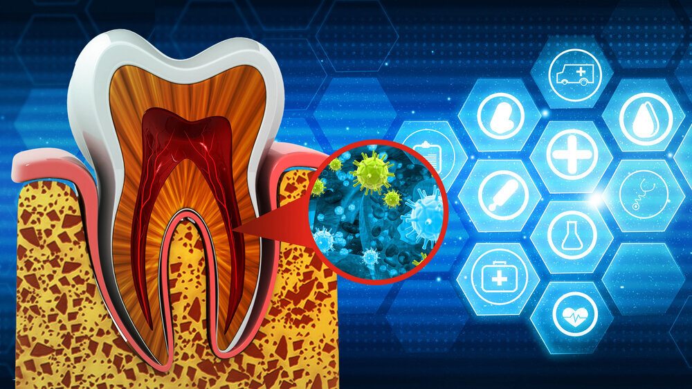 Human tooth bacterial infection. 3d illustration.. Parodontitis