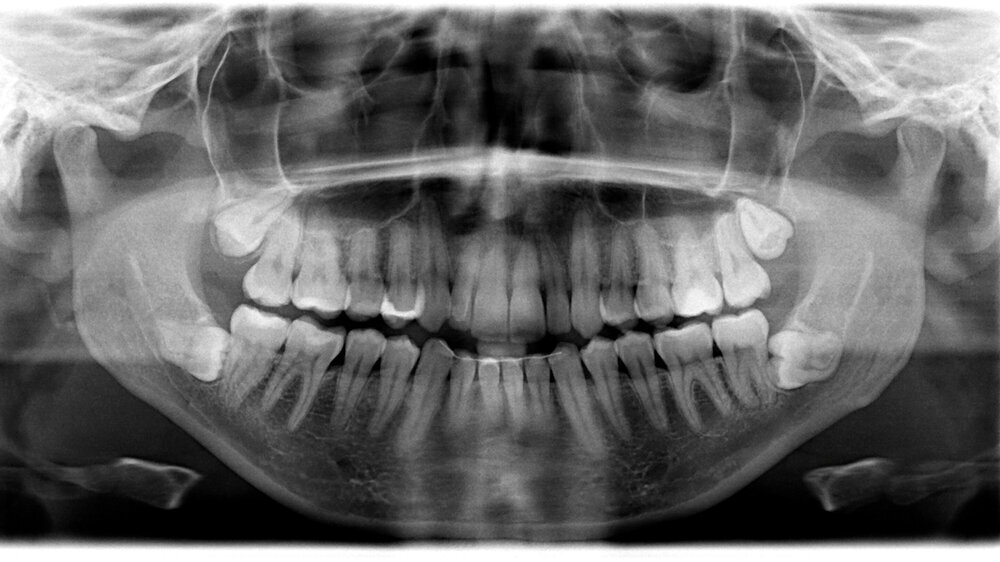 Orthopantomography, OPG X-ray DR digital wisdom teeth. panoramic film x ray dental. Noisy photo Symbolbild Orthopantomographie | Deutsch