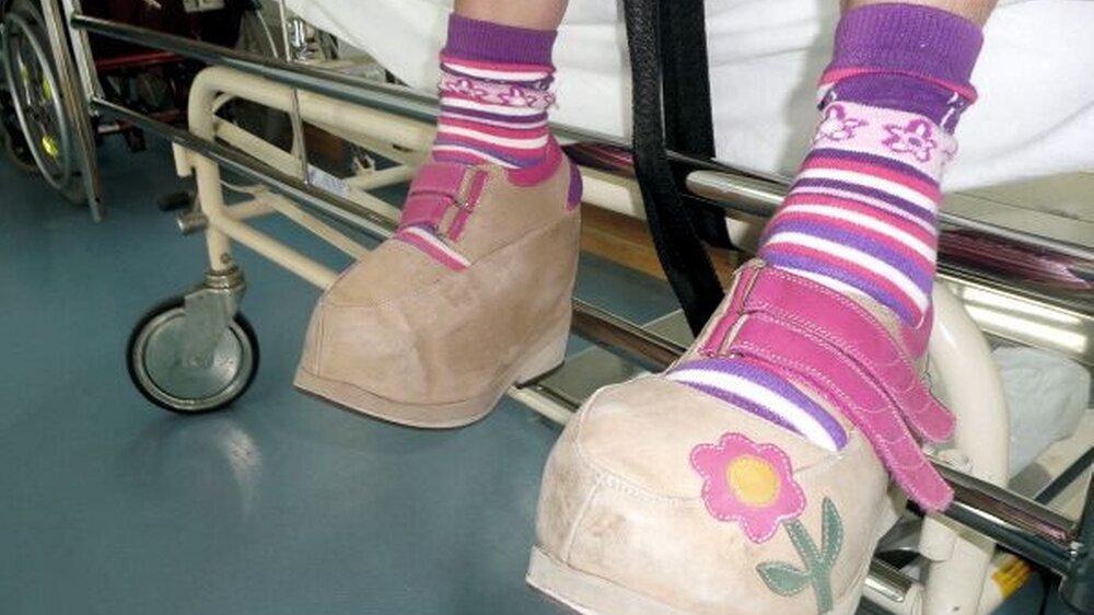 Bei dieser Patientin hatte das Wachstum eines Fußes nicht aufgehört. Es kam zum Riesenfuß, der natürlich besonderes Schuhwerk benötigte. | Bei dieser Patientin hatte das Wachstum eines Fußes nicht aufgehört. Es kam zum Riesenfuß, der natürlich besonderes Schuhwerk benötigte. |