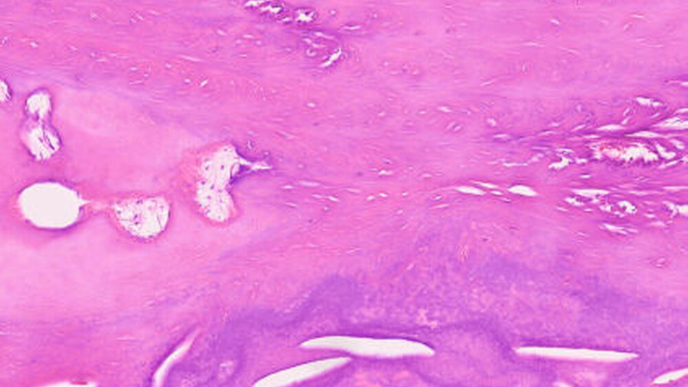 Histologisch zeigte sich organoid angelegter, relativ dichter Knochen, vereinbar mit der Diagnose eines zemento-ossifizierenden Fibroms. |