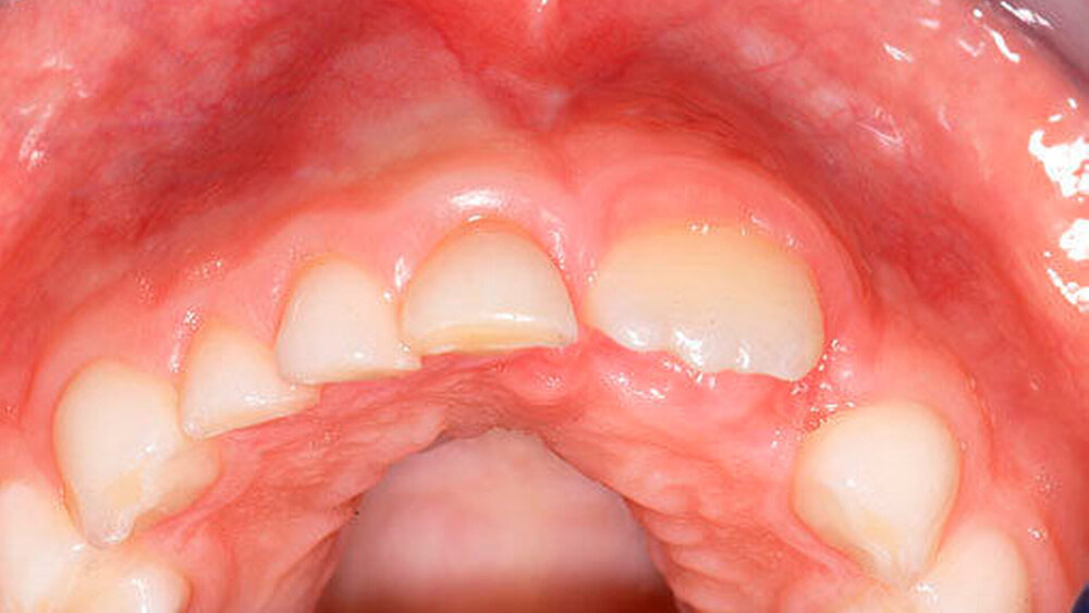 Abbildungen 1 bis 3: Überzähliger Milchzahn 52+ bei einem knapp achtjährigen Knaben mit verzögertem Durchbruch der bleibenden Oberkieferfronzähne. In der digitalen Volumentomografie erkennt man zudem einen überzähligen lateralen Schneidezahn 12+ (2: okklusale Ansicht) |