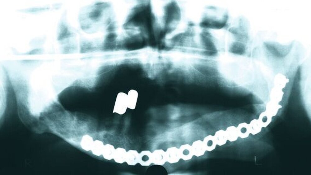 Abbildung 4: OPG von 2005 nach Tumor-OP und Rekonstruktion mit Beckenkamm. |