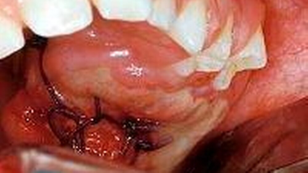 Abbildung 1: Enoraler Aspekt des Tumors im Bereich des linken Oberkiefers. Erkennbar ist die massive Vorwölbung der palatinalen Schleimhaut mit großflächigem Schleimhautdefekt und gelbfarbenem Tumorgewebe. Die sichtbaren Fäden wurden im Rahmen der Gew