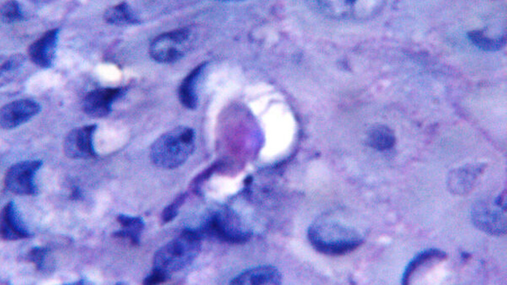 Der Parasit Entamoeba gingivalis dringt ins Zahnfleischgewebe ein und ernährt sich dort von Wirtszellen.