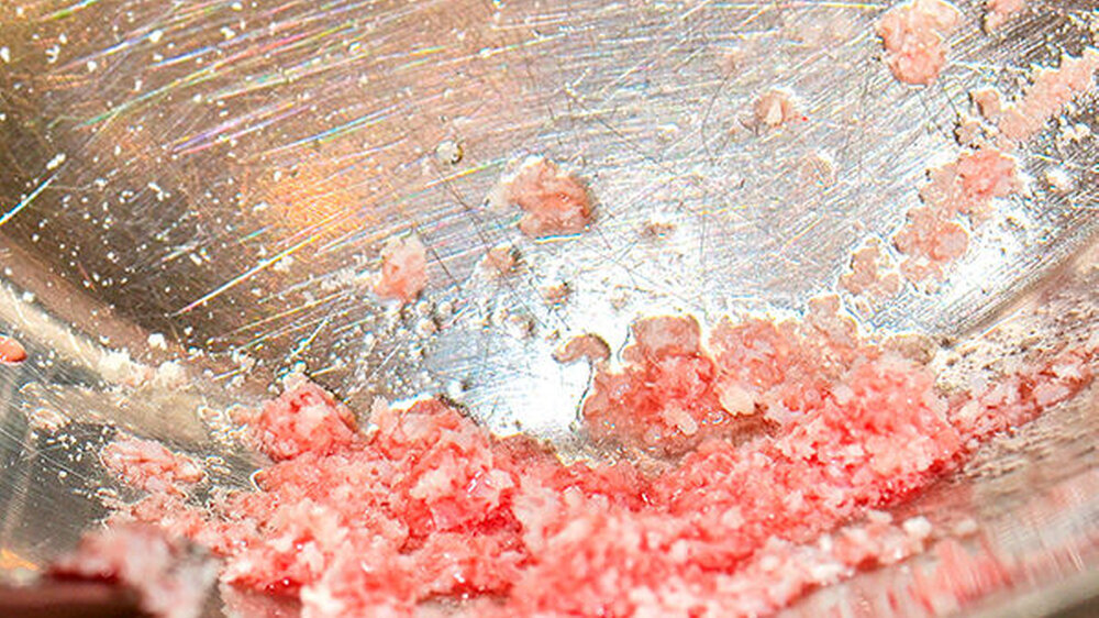 Vorbereitung des Knochenersatzmaterials (maxgraft spongiöse Granula, botiss biomaterials, Zossen, Deutschland) durch Mischung mit Eigenblut